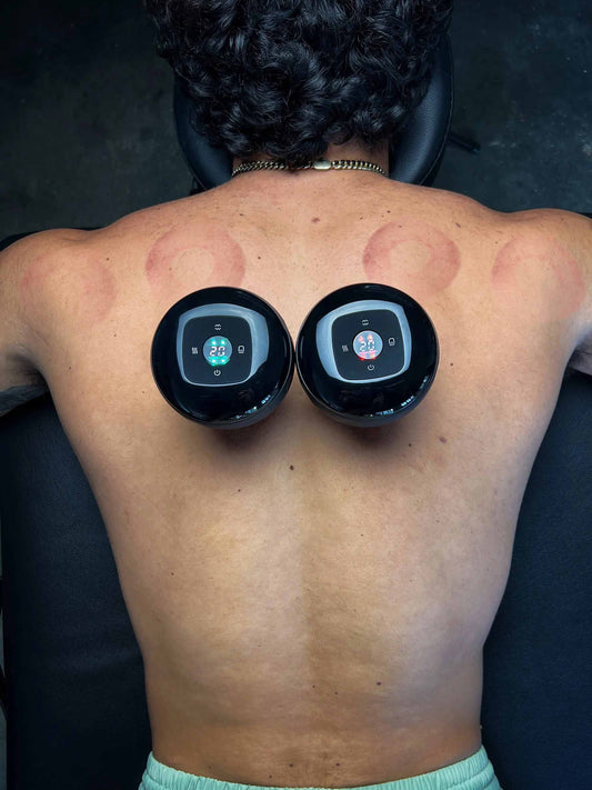 BENEFITS OF CUPPING THERAPY AT HOME