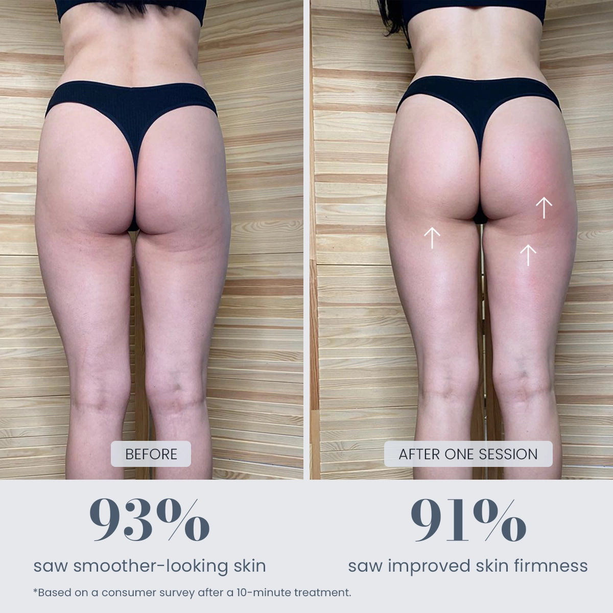 Before and after body contour appearance after one session with Revimus Anti-Cellulite Massager