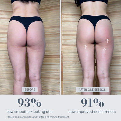 Before and after body contour appearance after one session with Revimus Anti-Cellulite Massager