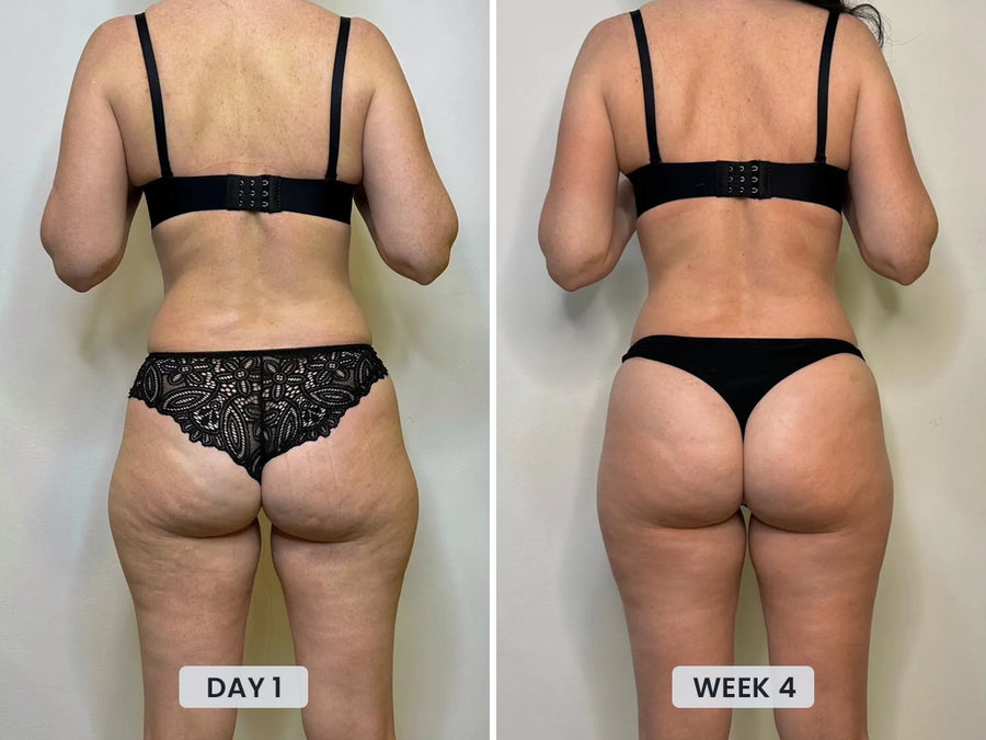 Before and after 4-week cellulite results using Revimus Anti-Cellulite Massager
