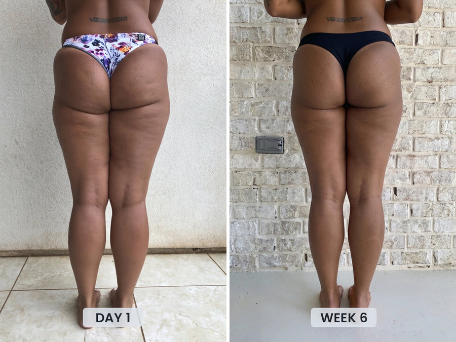Before and after cellulite results after 6 weeks using Revimus Anti-Cellulite Massager