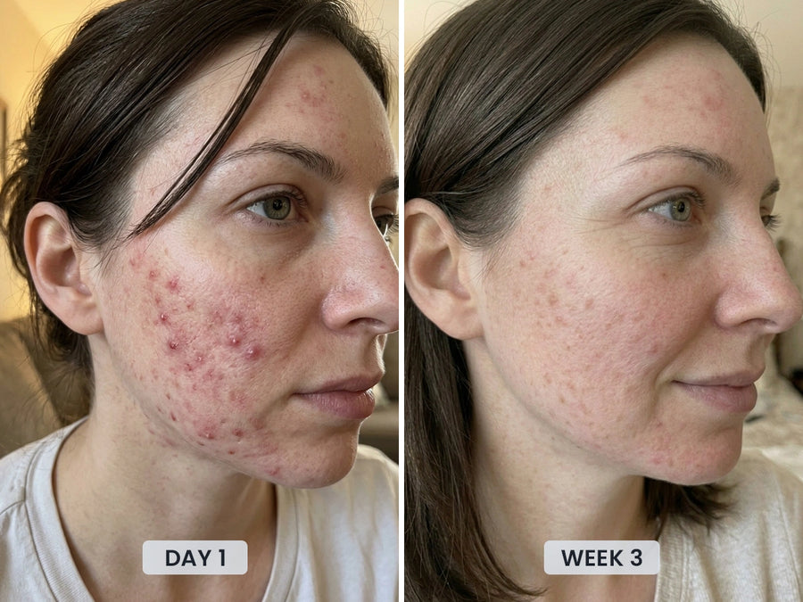 Visible improvement in acne-prone skin after 3 weeks using the Revimus LUMA Sculpting Wand