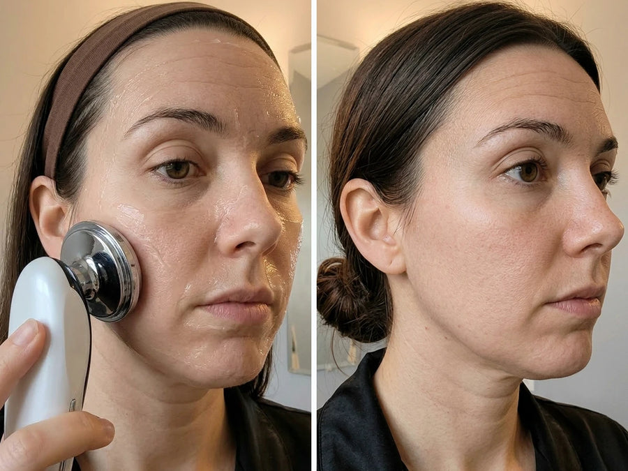 REVIMUS ORBIT™ before and after 1 session showing a more refreshed and well-rested appearance