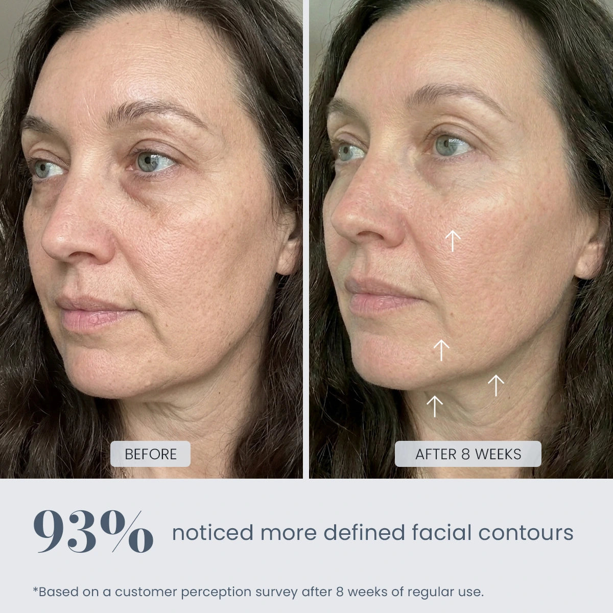 Before and after 8-week results showing more defined facial contours with REVIMUS ORBIT facial contour device