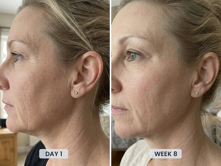 REVIMUS ORBIT™ before and after showing a firmer jawline and more defined facial contours
